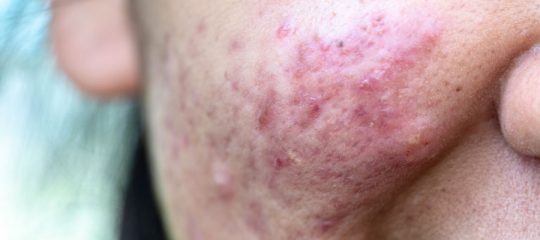 Psoriasis du visage traitement